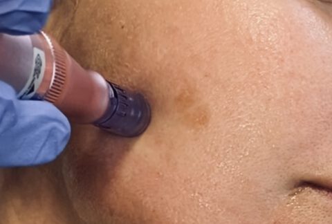 Mesotherapie